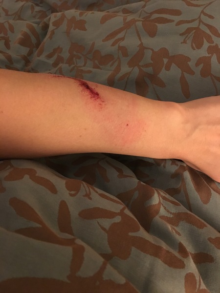 How do I know if bone is fractured, or is soft tissue damage?