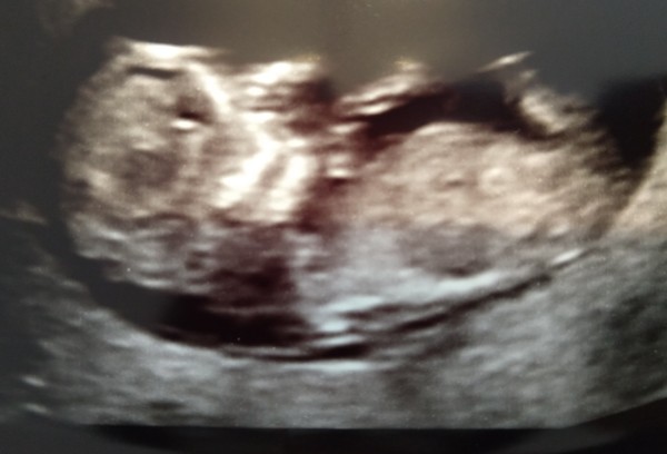 Dating scan next week - anyone else?