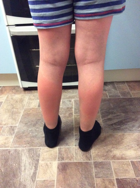 WHAts this blotchy rash?