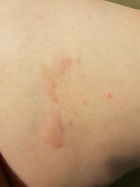 Chicken pox or shingles
