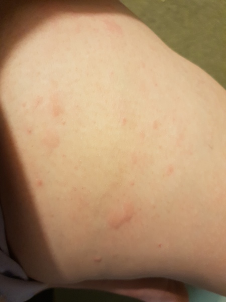 Chicken pox or shingles
