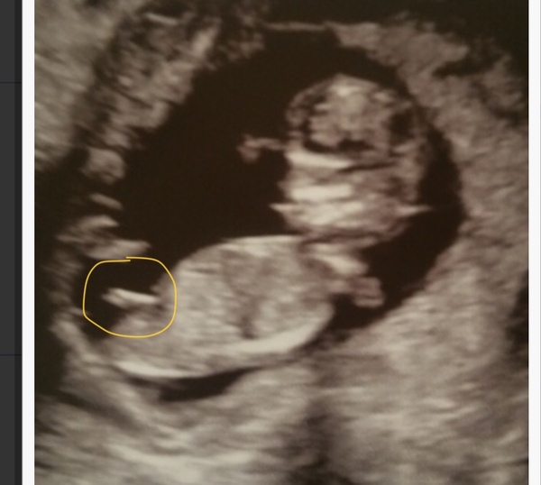 New babies sex