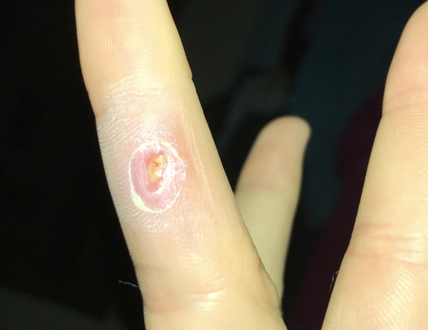 Normal wound right?