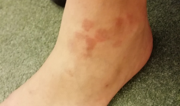 Guess the skin condition! *pics*