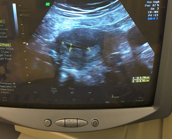 Miscarriage at 10weeks but positive test after 7