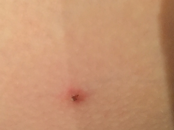 It’s ingrown hair time!