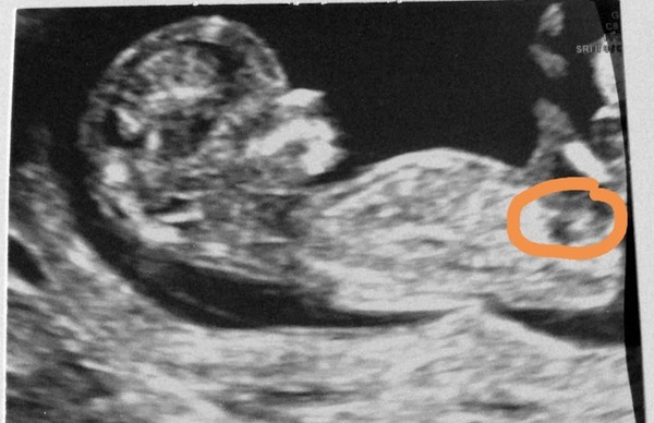 Gender guesses on NT scan? (12 + 5) - just for fun :)