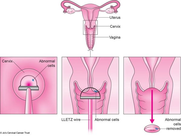 HPV vaccine