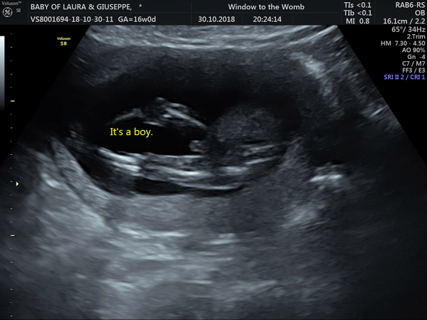 16+6w gender scan- do you agree?