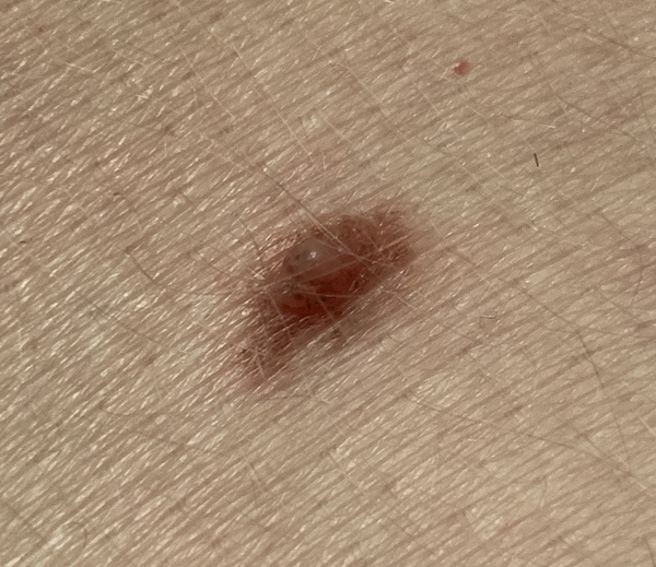 fk help could this be cancerous? (gross image)