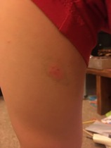 Anyone know anything about rashes?