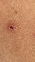 Any dermatologists about ?? I need some help