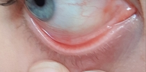AIBU to ask any medical professionals to look at photos of my eye waterline? (Anaemia?)