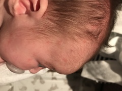 Milk spots or baby acne?