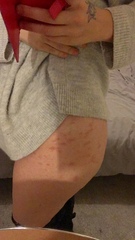 Rash on thighs while pregnant