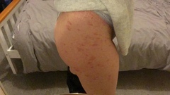 Rash on thighs while pregnant