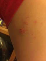 Anyone know anything about rashes?