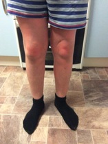 WHAts this blotchy rash?
