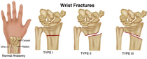What would you expect school to do when child breaks a bone at school?