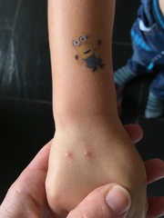 Chicken pox diagnosed - do you agree?