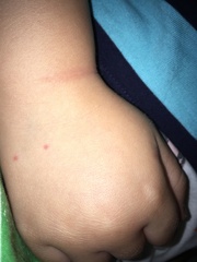 Chicken pox diagnosed - do you agree?