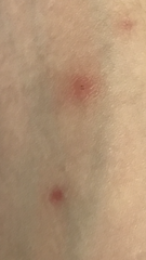 Any dermatologists about ?? I need some help