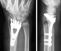 What would you expect school to do when child breaks a bone at school?