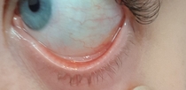AIBU to ask any medical professionals to look at photos of my eye waterline? (Anaemia?)