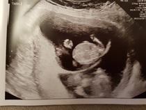First baby due June 2019!