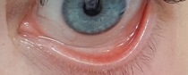AIBU to ask any medical professionals to look at photos of my eye waterline? (Anaemia?)