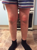WHAts this blotchy rash?