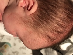 Milk spots or baby acne?