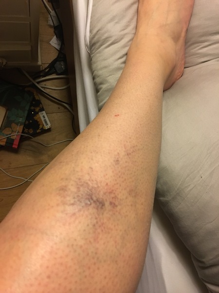 Pregnancy spider veins - help!