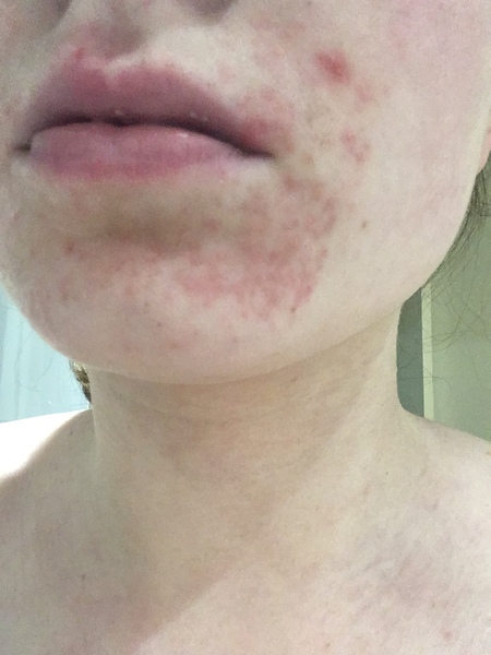 I have really unfortunate skin (pic)