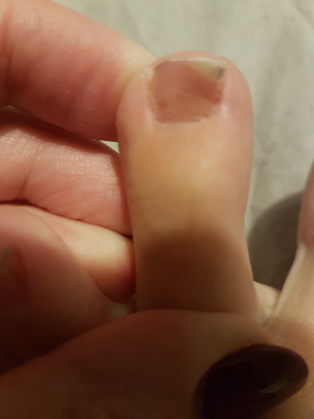 To wonder what this is... *picture of foot and toe attached don't open if you don't like feet *