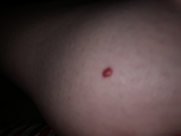 Red lump on leg - help