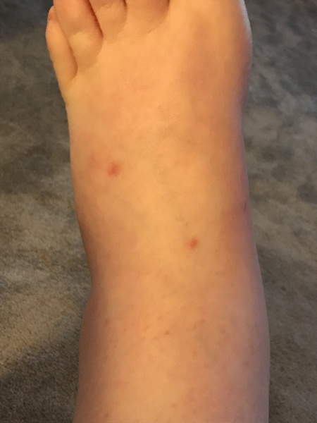 Being bitten