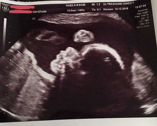 Gush of blood at 12 weeks? Terrified!