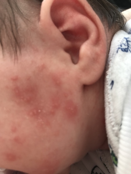 Baby face rash