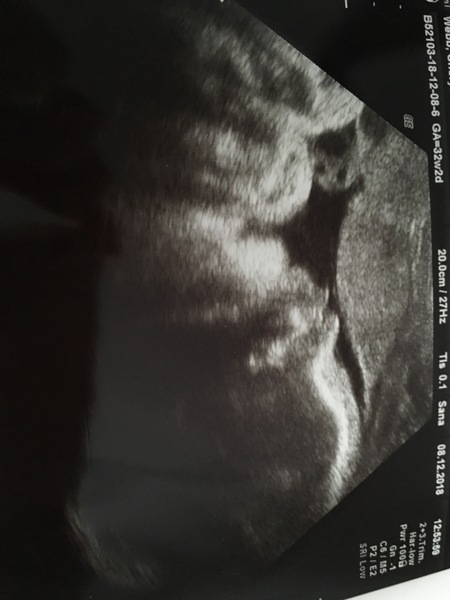 32 week scan gender