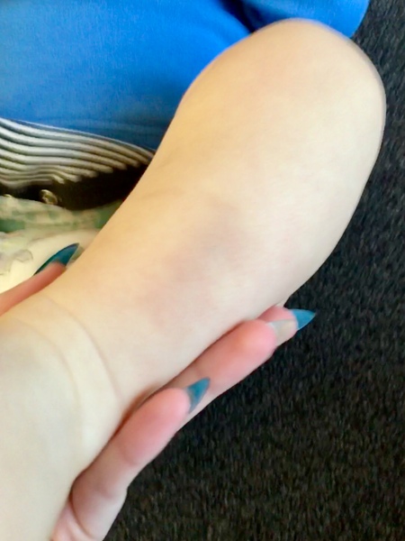 DP bruised my baby