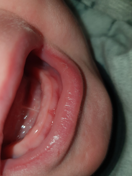 5 year old recurring viral wheeze/cough :(