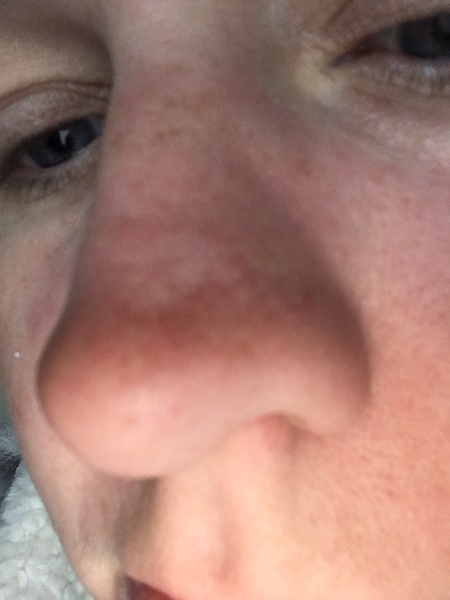 I've just had cancer removed from my face