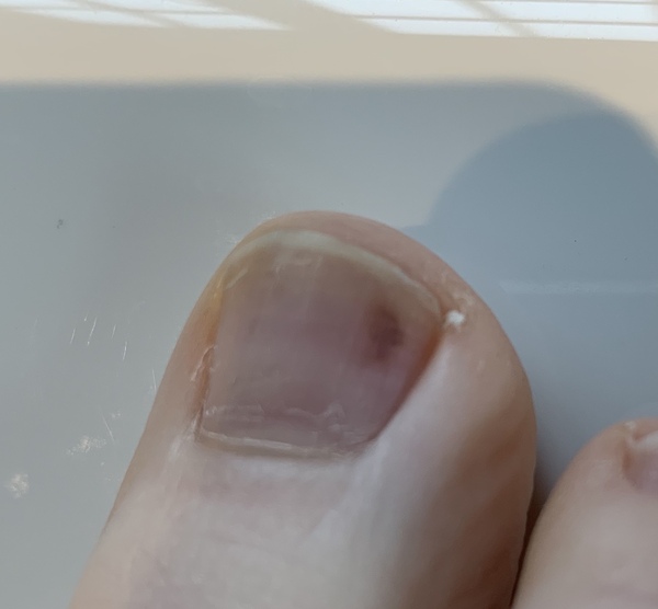 To wonder what this is... *picture of foot and toe attached don't open if you don't like feet *