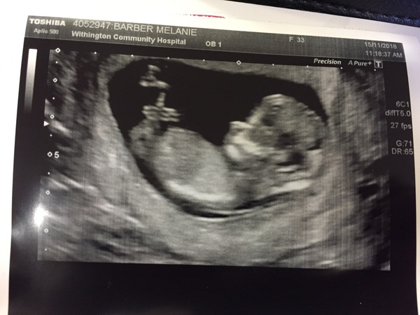 Boy or girl? Skull theory 12 weeks 3 days.