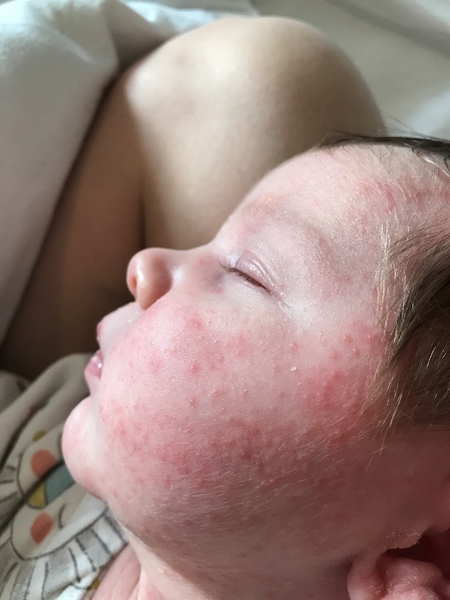 Baby face rash