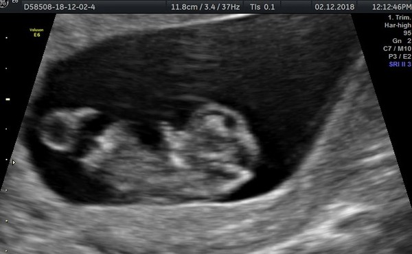 July 2019 Part 4 - Still in the 1st Trimester