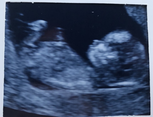 12 week scan nerves