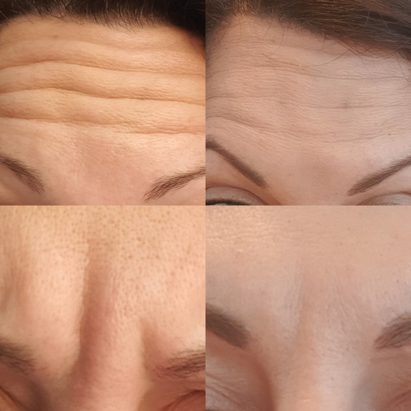 Botox diary