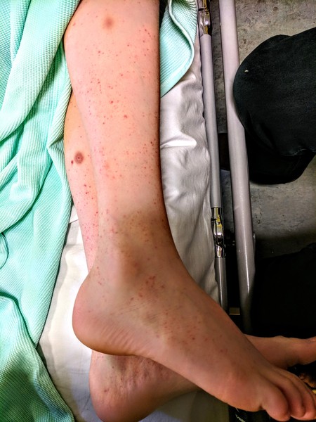 Weird rash on lower legs